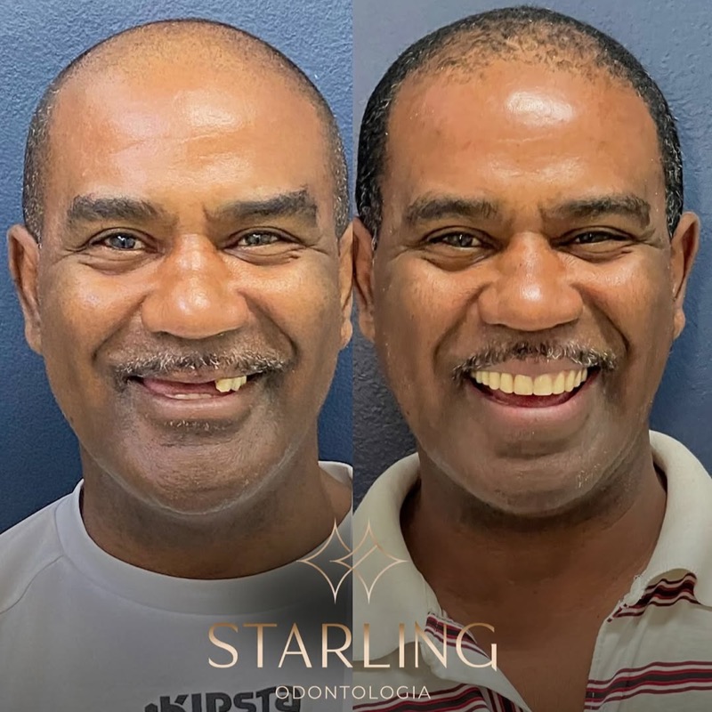 Resultado de Implante 1